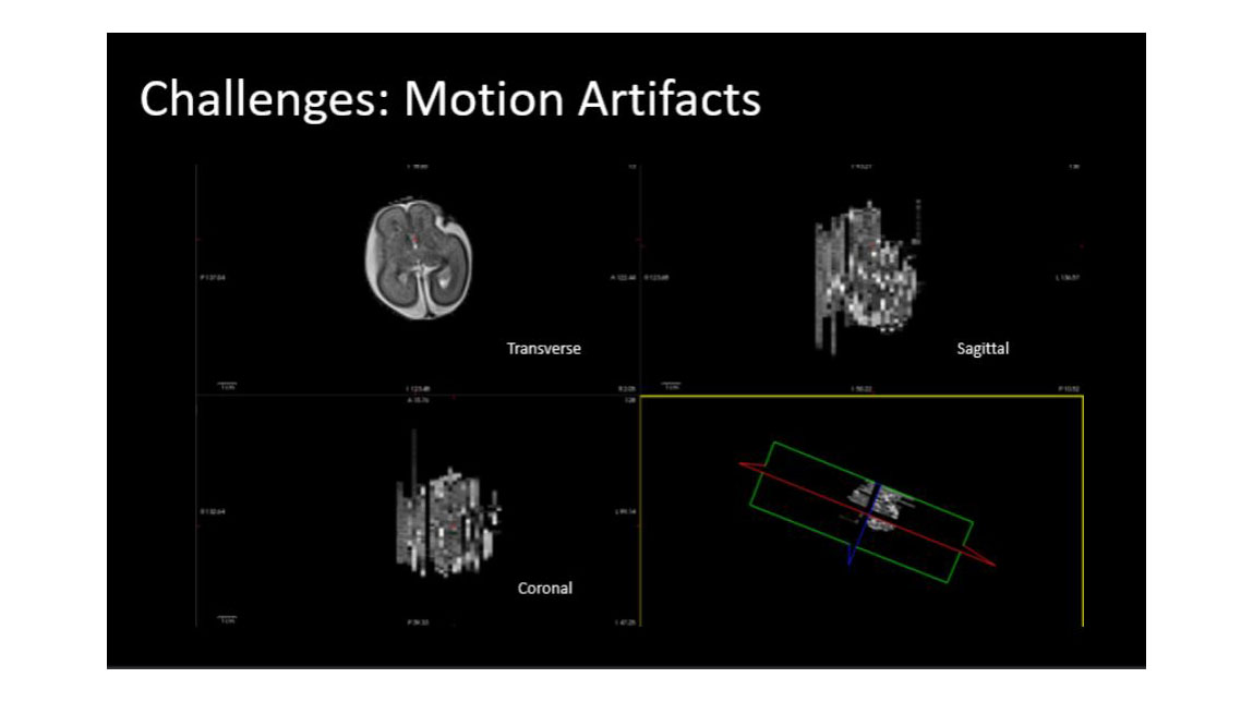 Fetal MRI with motion artifacts